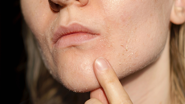 Descamación de la piel en la cara